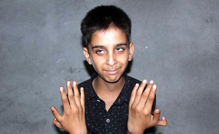 Файзан Ахмад Наджар шесть пальцев на руке