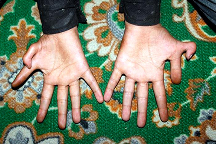 Файзан Ахмад Наджар шесть пальцев на руке 2