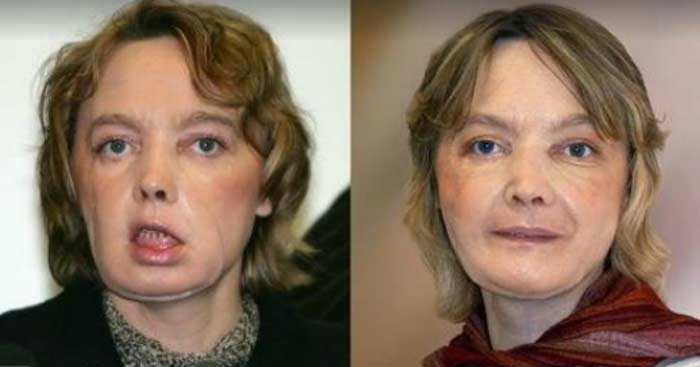 Изабель Динуар до и после пересадки лица