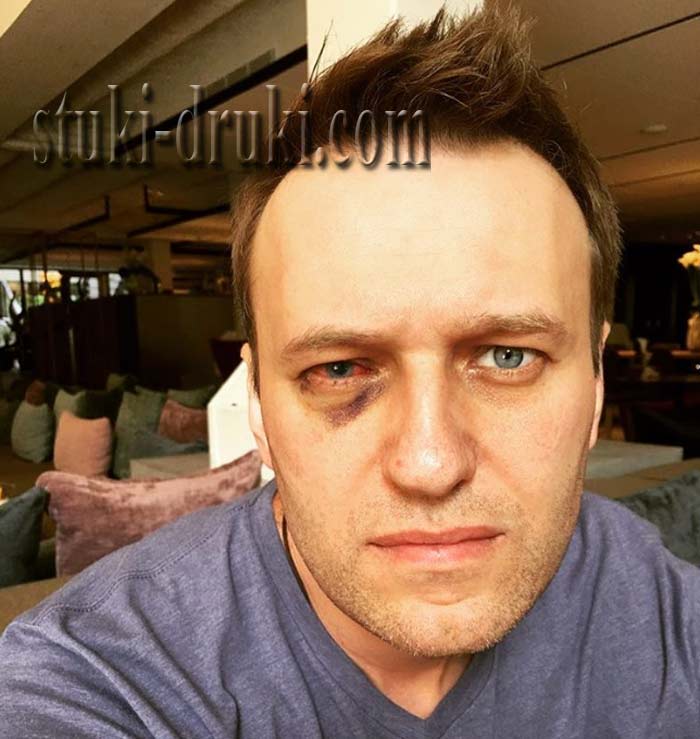 Алексей Навальный подбитый глаз