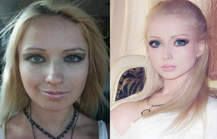 Одесская Барби Валерия Лукьянова до и после пластики