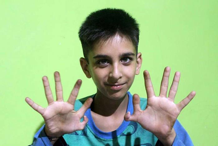 Файзан Ахмад Наджар шесть пальцев на руке 3