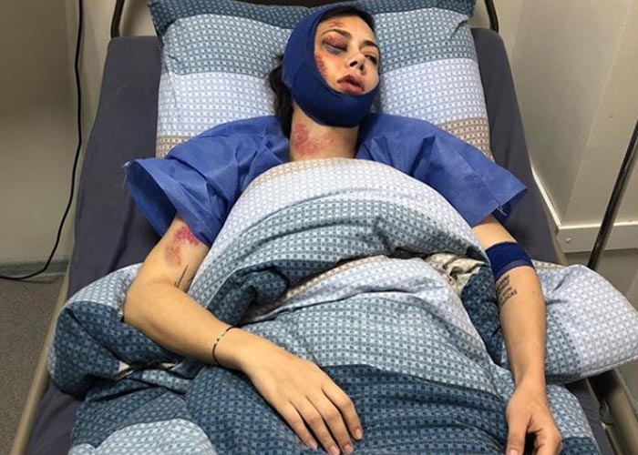 избитая Настасья Самбурская в больнице