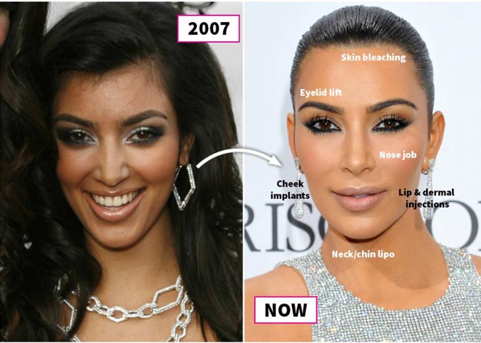 Ким Кардашьян до и после пластики
